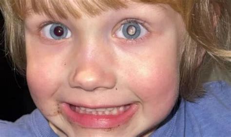 Toddlers Rare Glassy Eye Mistaken For Conjunctivitis Turns Out To Be