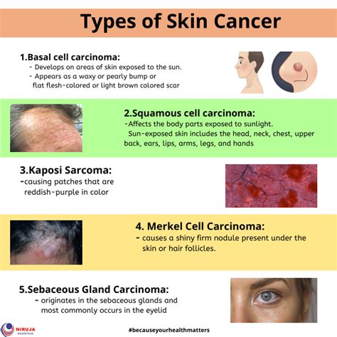 Types Of Skin Cancer