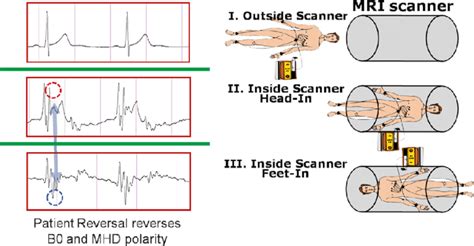 3 Ecg Acquired Outside I And Both Head Ii And Feet Iii Inside An