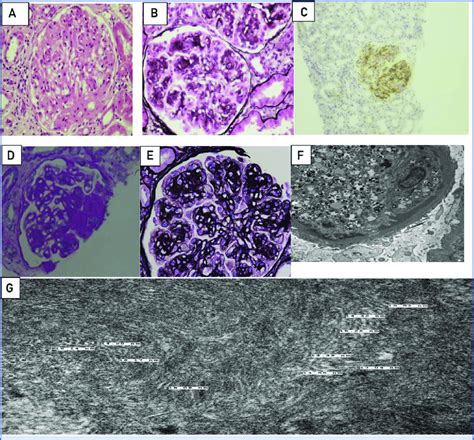 Pathology Of Membranoproliferative Glomerulonephritis With Monoclonal Download Scientific