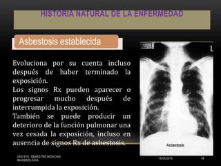 Asbestosis PPT