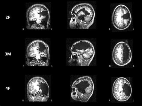 High-resolution structural MRI from three of the four examined patients... | Download Scientific ...