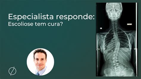 Escoliose Tem Cura Especialista M Dico Ortopedista E Cirurgi O De