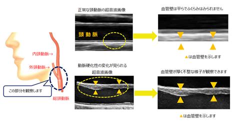 頸動脈超音波検診 公益財団法人宮崎県健康づくり協会