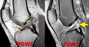 Anterior Cruciate Ligament Mri