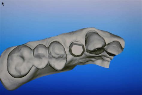 5 Axis Dental Design Center Scanning Jig For Itero Bone Level Implant