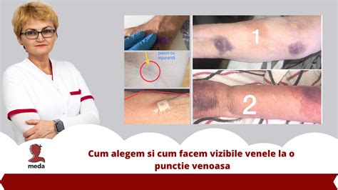 Webinar Cum Alegem Si Cum Facem Vizibile Venele La O Punctie Venoasa