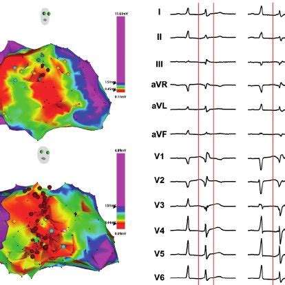 Electroanatomical Maps Of The Left Ventricle In A Patient After