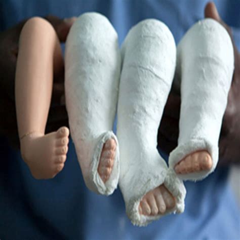 Clubfoot treatment in Iran | Best doctors & clinics | Free consultation