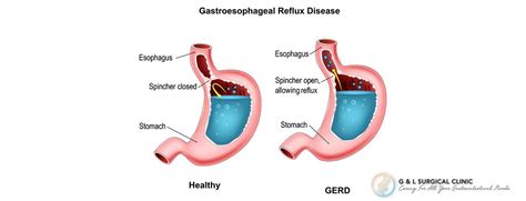 8 Common Conditions Detected Through A Gastroscopy G L Surgical