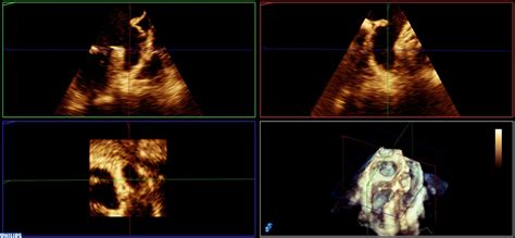 Left Atrial Appendage Anatomy Function And Importance In Thrombus