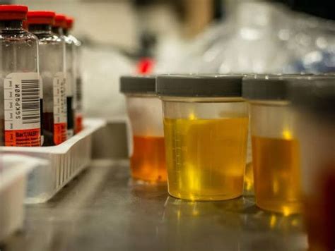 Urinalysis Types Process And Results Interpretation