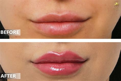 Best Lip Fillers In Dubai Lip Augmentation Dubai