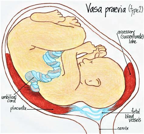 Vasa Previa Definition Causes Symptoms Diagnosis Ultrasound And Management