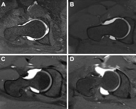 Figure 2 From Clinical And Radiographic Presentation Of Capsular