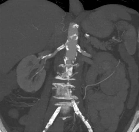 Aortobifemoral Bypass For Occlusive Aortic Disease In A Patient With A Duplicate Inferior Vena