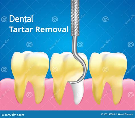 Scaling Tartar And Cleaning Teeth Dental Care Concept Realistic