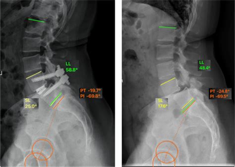 Transforaminal Lumbar Interbody Fusion With An Expandable Interbody