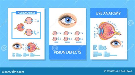 Astigmatism Vector Illustration Diagram, Anatomical Scheme ...