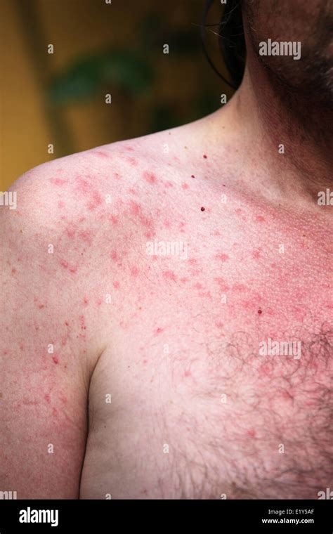 Scalp Sun Rash At Gustavo Christensen Blog