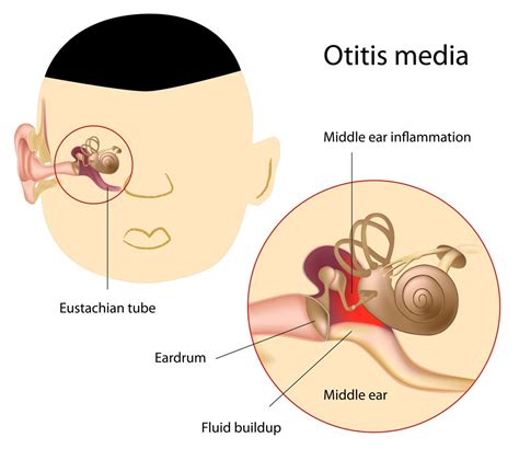 Postnasal Drip in Children - Pediatric Pulmonologists