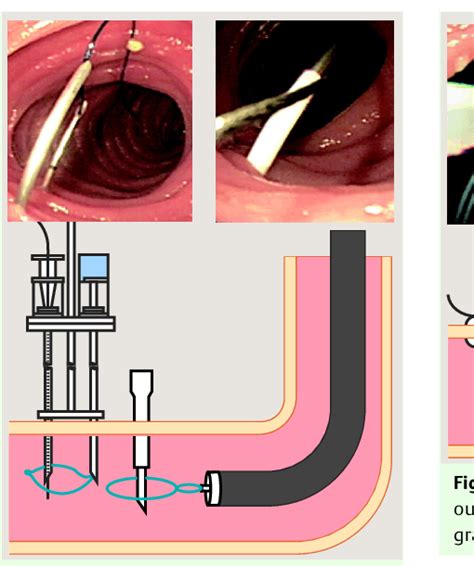 Figure 2 From Direct Percutaneous Endoscopic Jejunostomy Using A