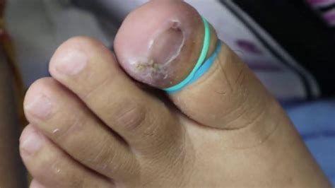 Ep1568 Infected Ingrown Toenail Removal 👣 น่าจะใหญ่แต่ผิดคาด 😝 This