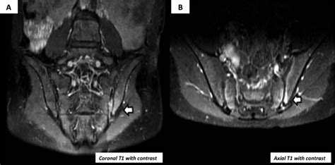 Magnetic Resonance Imaging Of The Sacrum Case 2 T1 Weighted Coronal