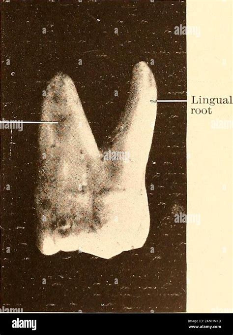 Principles And Practice Of Operative Dentistry Disto Mesio Buccal