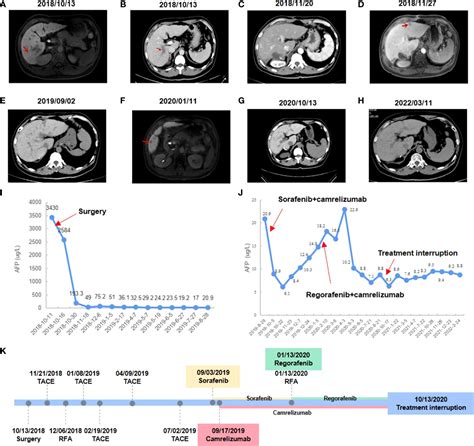 Frontiers Case Report Primary Hepatocellular Carcinoma With Portal