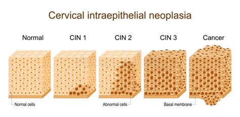Cervical Dysplasia Cervical Cancer Stock Vector Illustration Of