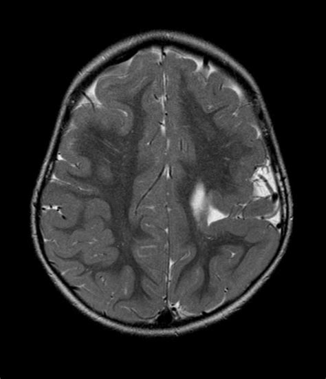 Schizencephaly Closed Lip Radiology Case Radiopaedia Org Lips