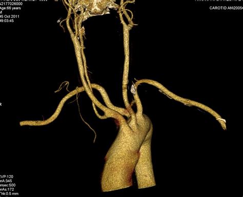 Vrd Image Aberrant Right Subclavian Artery Which Originates From The Download Scientific