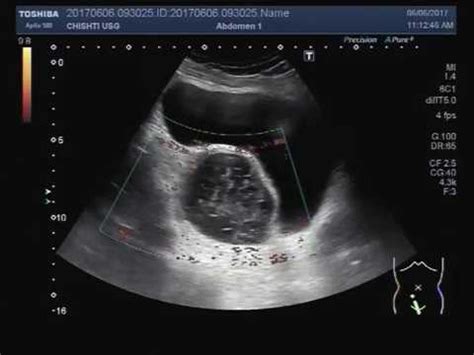 What Do Ovarian Cysts Look Like On Ultrasound