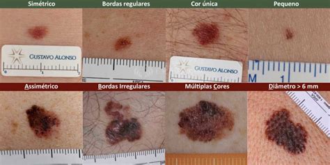 Pintas Ou Sinais Benignos Nevo Melanocítico