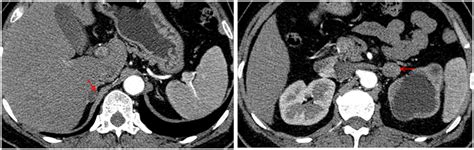 Adrenal Enhanced Computed Tomography Ct Image Showing A 16 × 13 Mm