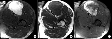 A Axial T2 Weighted Fat Saturated Image B Axial T1 Weighted Image