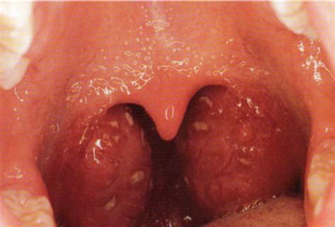 Beginning Of Tonsillitis