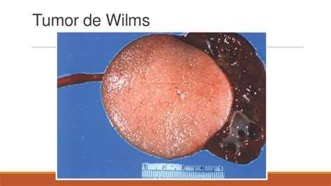 Tumor De Wilms