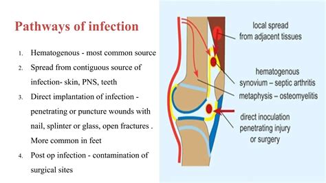 Imaging In Infections Of Bones And Joints2 Pptx