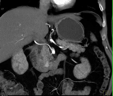 Subtle Vascular Metastases To Pancreas From Renal Cell Carcinoma