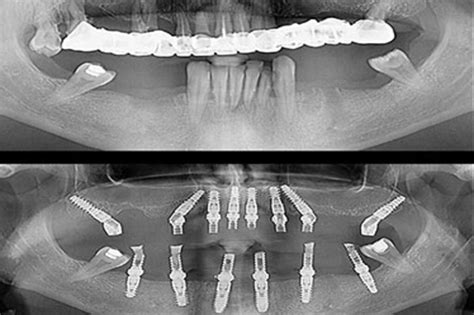 Zygomatic Implants Dental