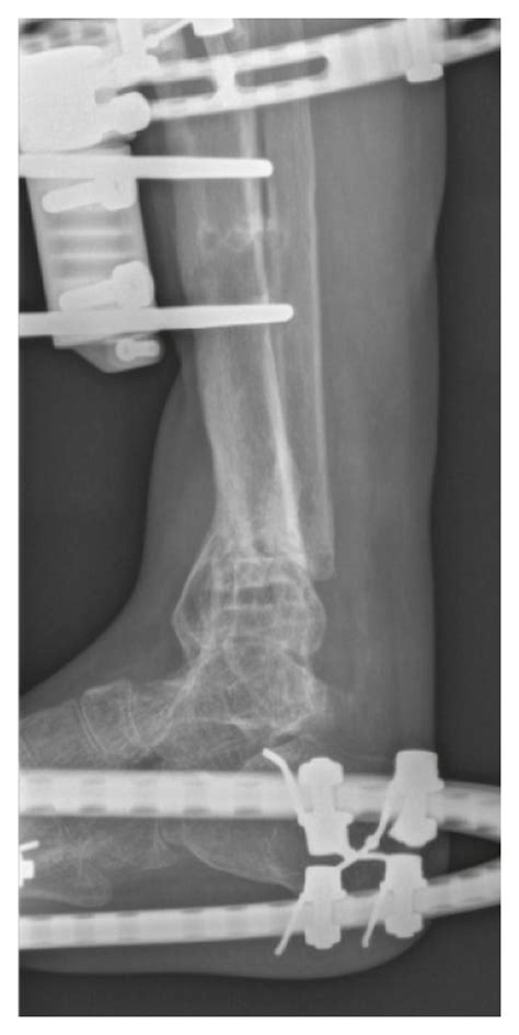 Af Both The Appearance And The X Rays Of The Injured Lower Leg