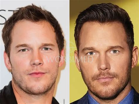 Chris Pratt Hair Transplant Before And After