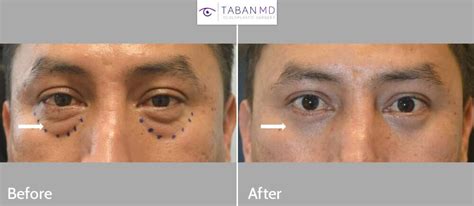 Lower Blepharoplasty Before And After