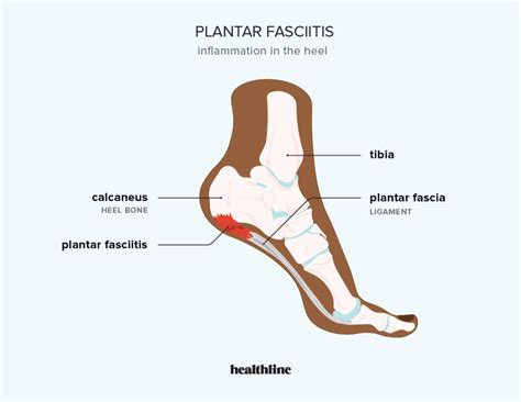 Plantar Fasciitis - Motus Physical Therapy