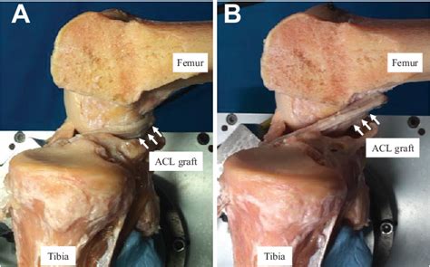 Figure 5 From A Biomechanical Comparison Of 2 Over The Top Anterior