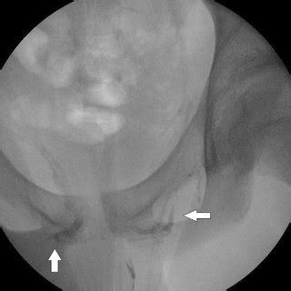 Intraoperative Fluoroscopy Demonstrating A Collateral Circulation