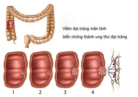 Viêm đại tràng Những điều cần biết đầy đủ nhất