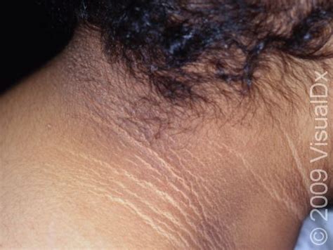 Acanthosis Nigricans Neck